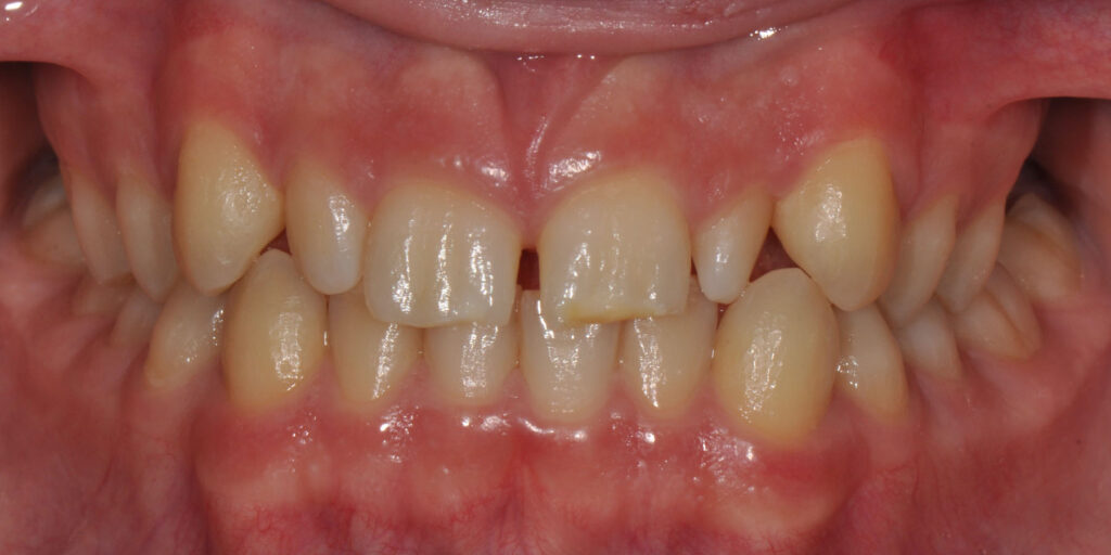 Before
