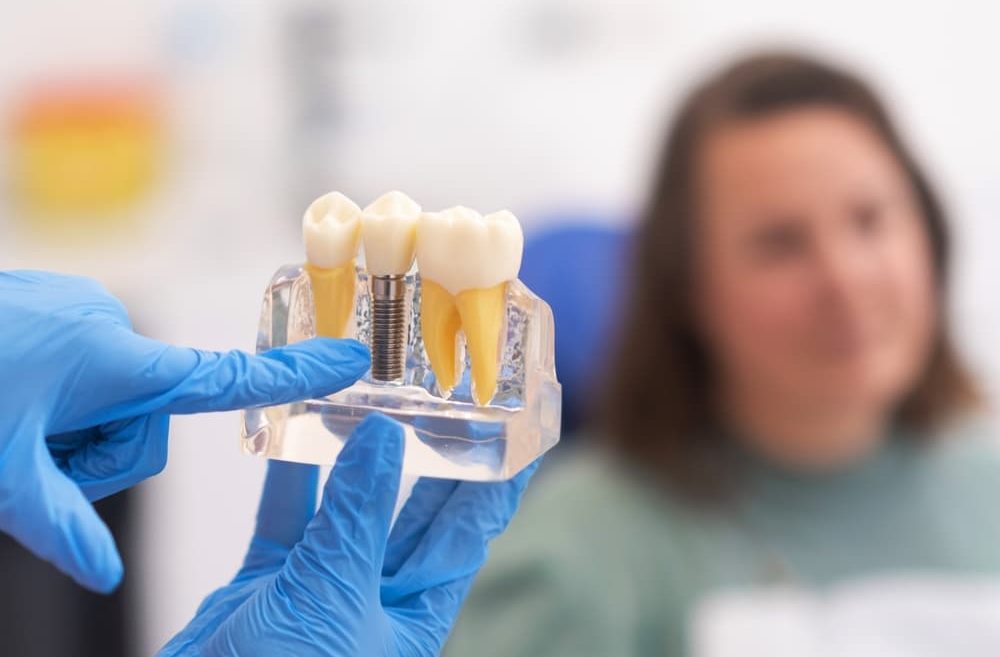 Dental Implant