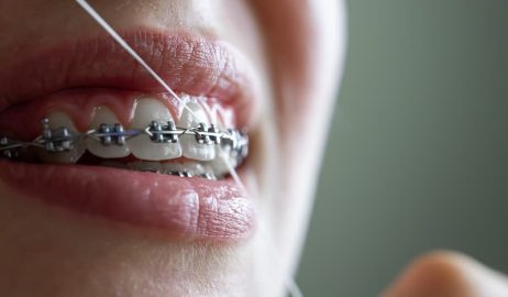 How Metal Braces Improve Oral Function and Alignment