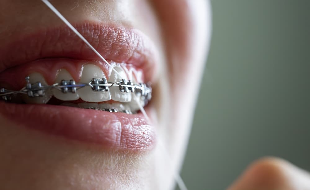 braces metal