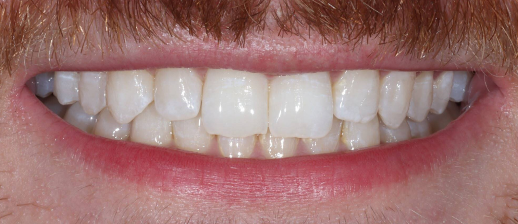 After