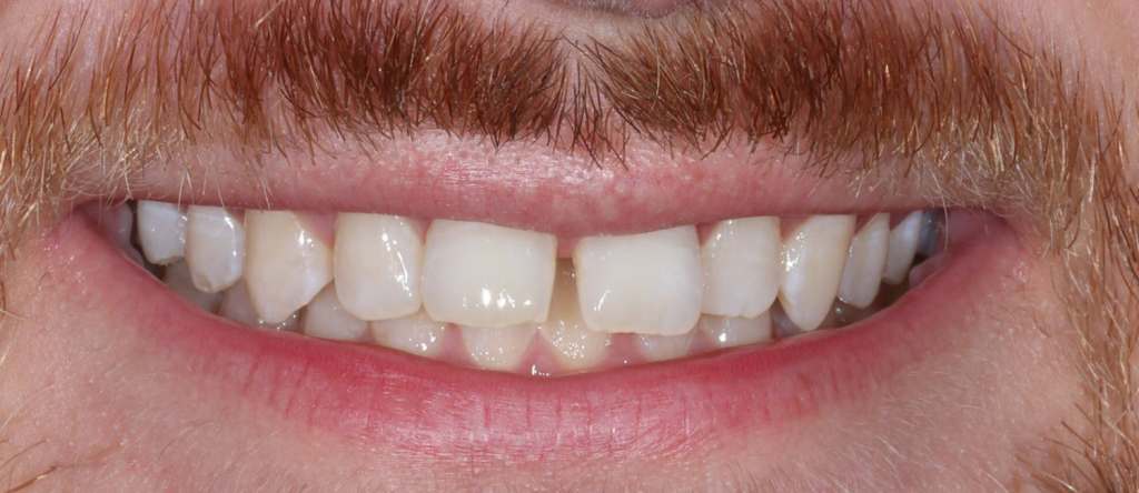 Before