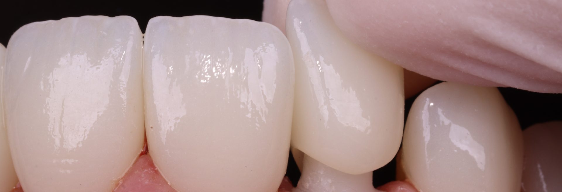 Turkey Teeth: What the Treatment Actually Involves