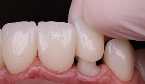 Turkey Teeth: What the Treatment Actually Involves